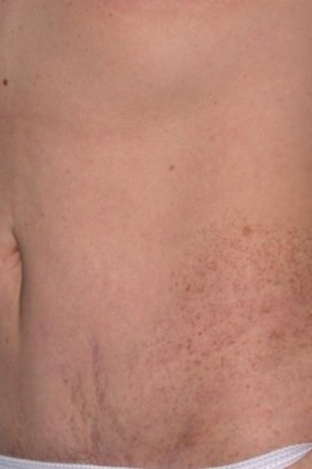 After image 2 Case #81196 - Mini-abdominoplasty and Liposuction
