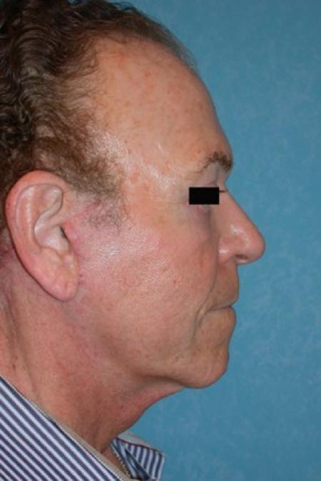 After image 1 Case #81376 - Lower Face and Neck Lift with Lower Blepharoplasties