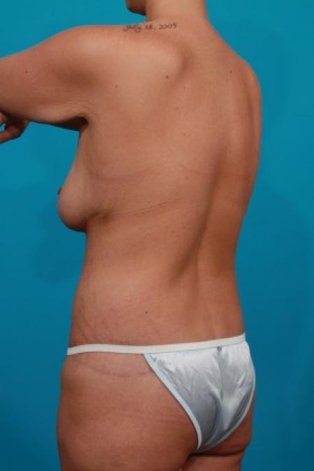After image 4 Case #83026 - Surgery after MWL