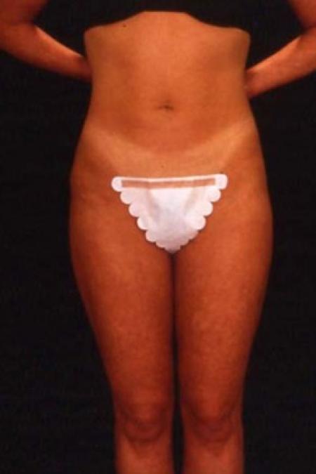 After image 1 Case #81531 - Liposuction