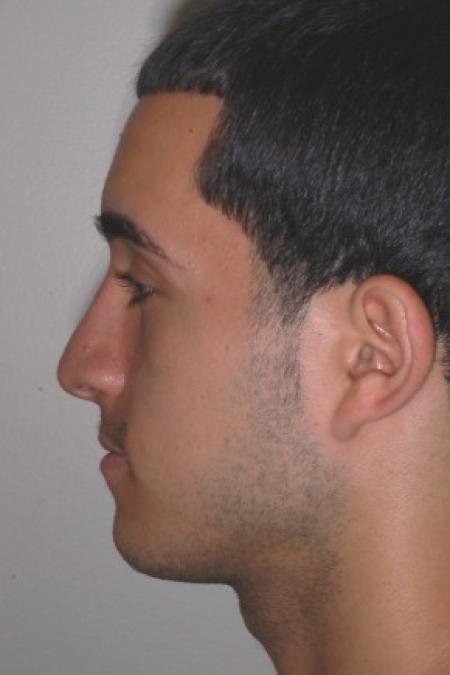 After image 2 Case #87211 - Rhinoplasty