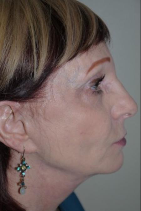 After image 3 Case #82306 - 65 year old, 8 years after facelift and endoscopic brow lift