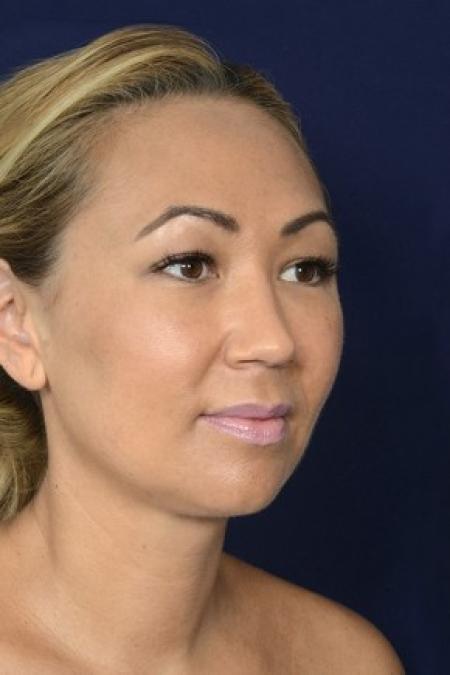 After image 2 Case #87151 - Neck / Chin Liposuction