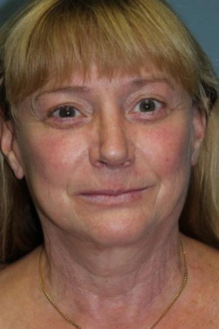After image 1 Case #81081 - Facelift