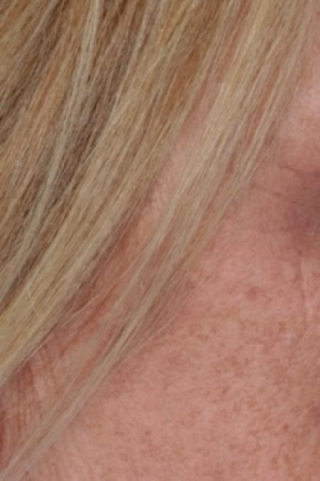 After image 2 Case #80591 - Eyelid
