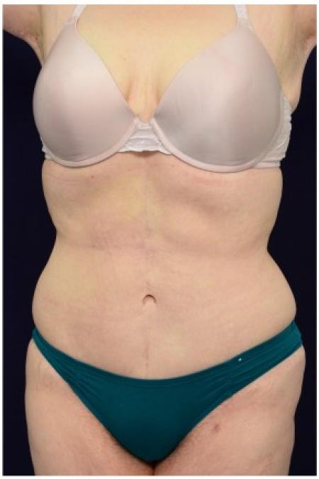 After image 2 Case #82111 - Tummy Tuck