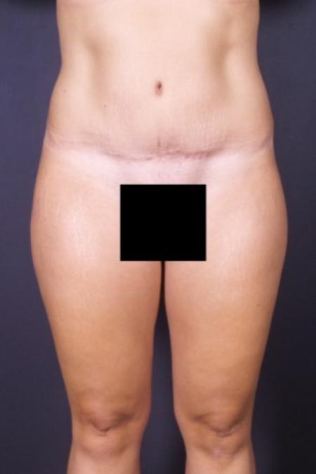 After image 1 Case #84231 - Abdominoplasty 