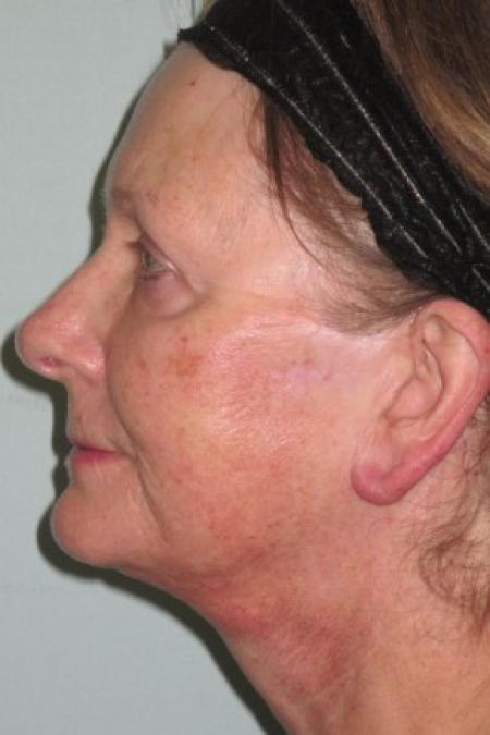 After image 2 Case #82681 - 67 Year Old Woman's Facial Rejuvenation
