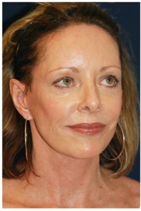 After image 3 Case #82041 - Full Facial Rejuvenation