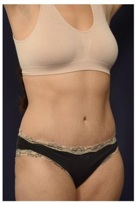 After image 2 Case #84781 - Abdominoplasty