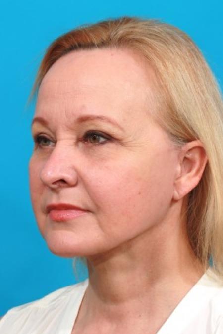 After image 2 Case #85641 - Full Facial Rejuvenation