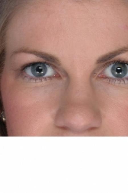 After image 1 Case #80586 - Upper Blepharoplasty