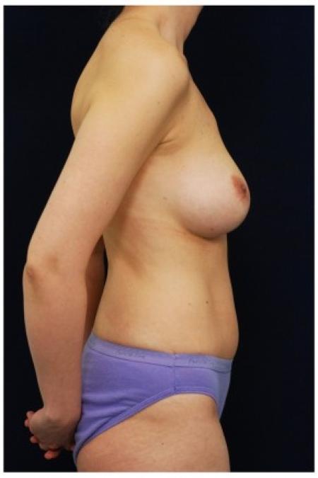 After image 3 Case #82091 - Mommy Makeover