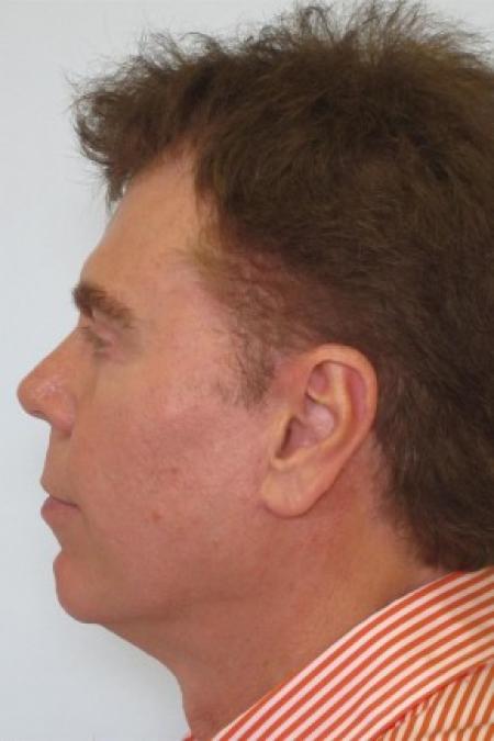 After image 2 Case #82691 - 65 Year Old Male Facial Rejuvenation