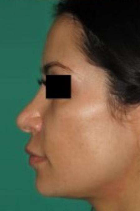After image 3 Case #85656 - Rhinoplasty 