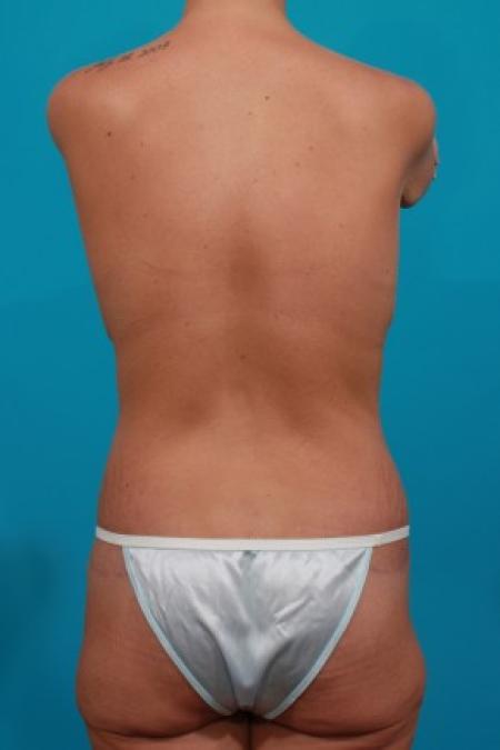 After image 5 Case #83026 - Surgery after MWL