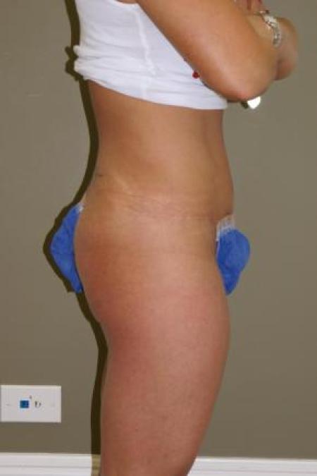 After image 2 Case #80851 - Liposuction