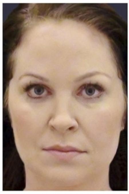 After image 1 Case #86326 - 40 year old woman treated with Voluma