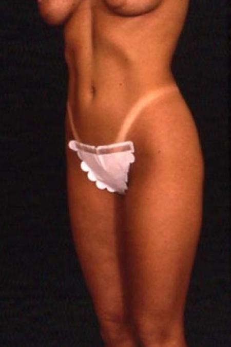 After image 1 Case #81521 - Liposuction