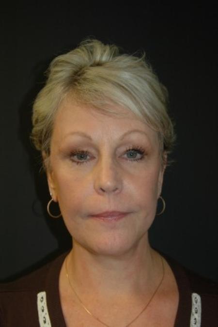 After image 1 Case #81311 - Facelift, Fat Transfer, Lower Blepharoplasty