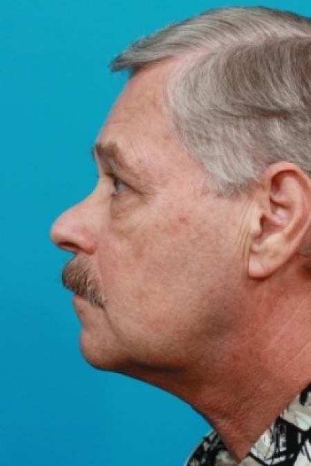 After image 2 Case #78926 - Upper Blepharoplasty