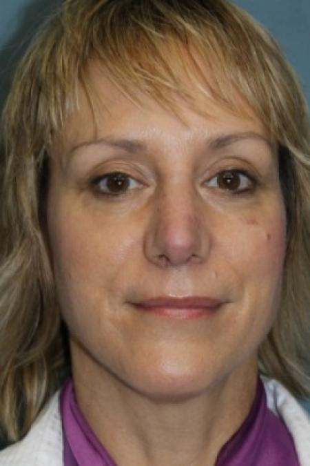 After image 1 Case #81166 - Nose Reshaping