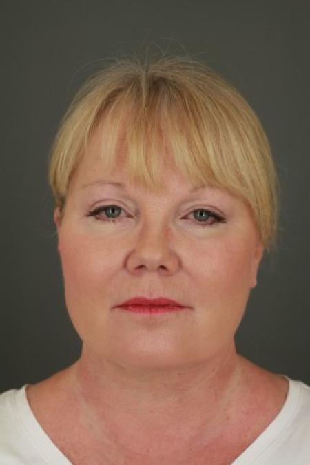 After image 1 Case #83171 - 61 year-old facial rejuvenation patient