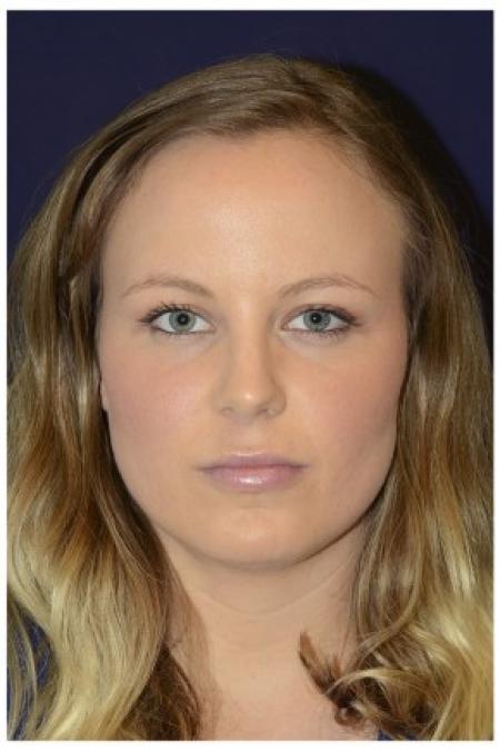 After image 1 Case #86336 - 26 year old woman treated with fillers