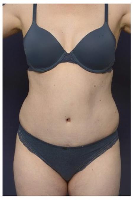 After image 1 Case #84496 - Abdominoplasty