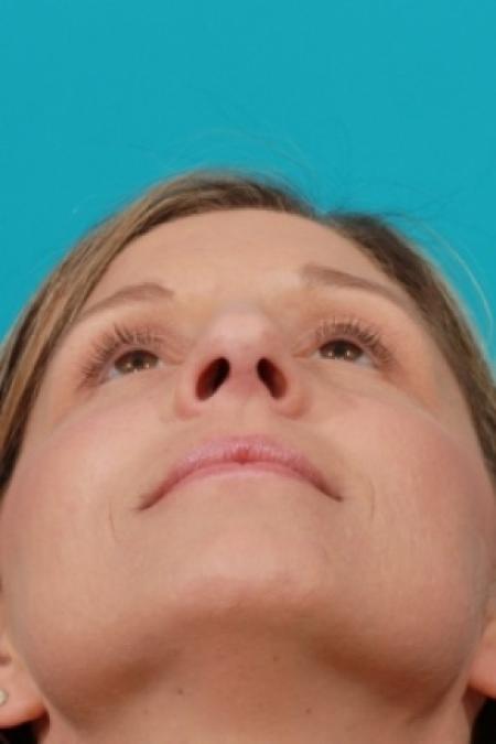 After image 4 Case #80521 - Open Rhinoplasty