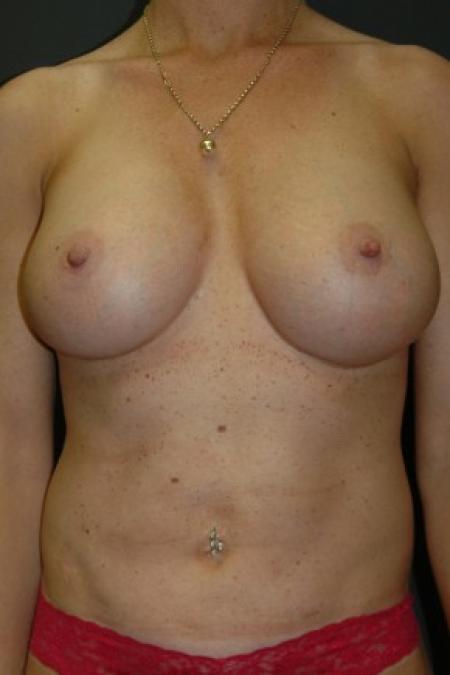 After image 1 Case #81351 - "Mommy Make-Over" Breast Augmentation and Abdominoplasty using Allergan Style 410-FF535cc
