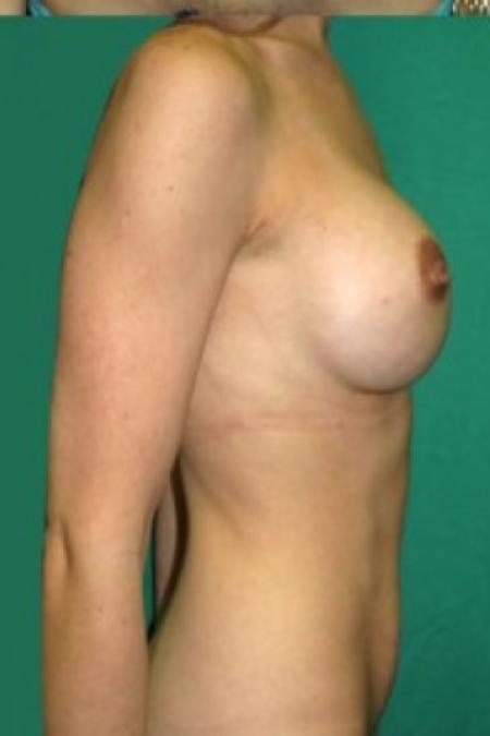 After image 2 Case #85681 - Mommy Makeover 