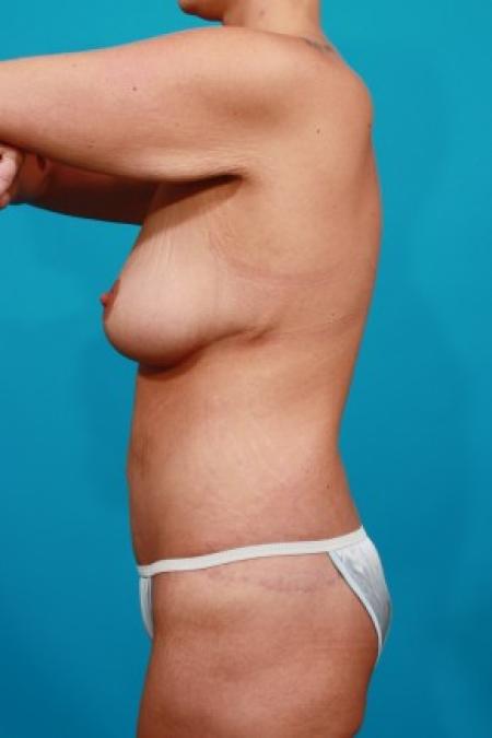 After image 3 Case #83026 - Surgery after MWL