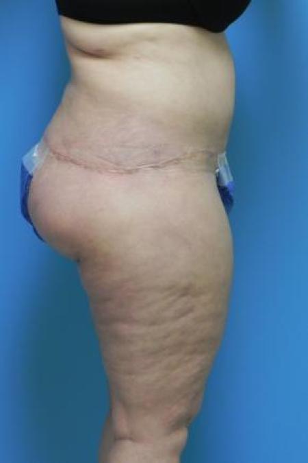 After Case #80956 - Lower body lift and medial thigh lift