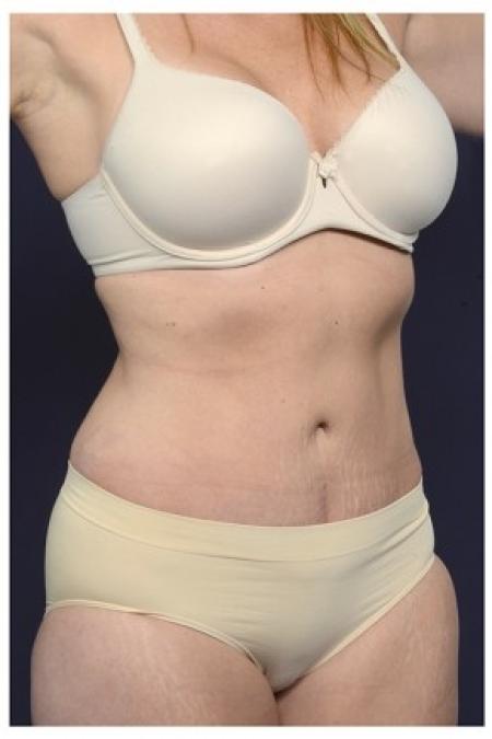 After image 2 Case #86201 - 40 year old woman treated with an Abdominoplasty