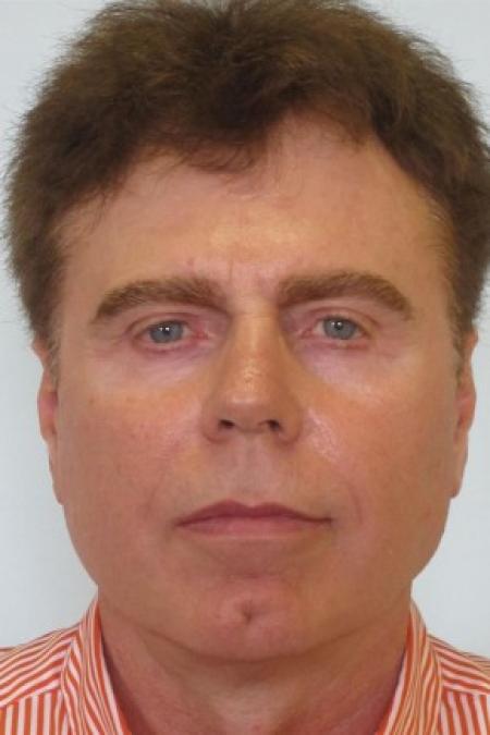 After image 1 Case #82691 - 65 Year Old Male Facial Rejuvenation