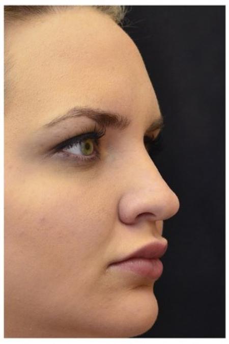After image 2 Case #86346 - 25 year old woman treated with nonsurgical rhinoplasty