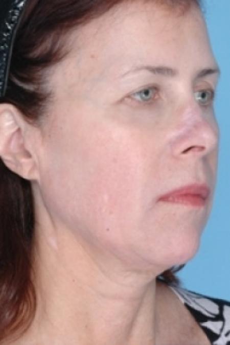 After image 2 Case #79311 - Non-Surgical Focused Ultrasound