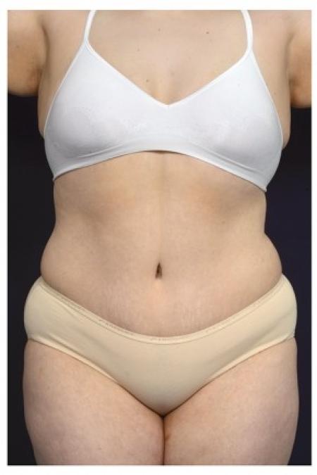 After image 1 Case #86901 - Abdominoplasty