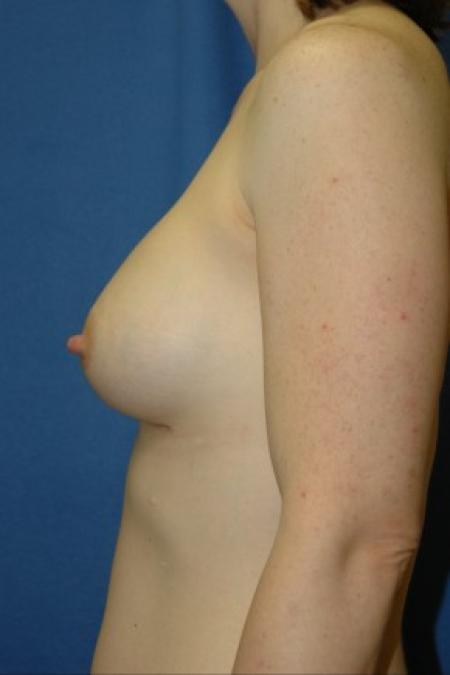 After image 3 Case #81336 - Breast Augmentation using Allergan Style 410-MF335cc