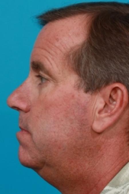 After image 2 Case #78876 - Lower Blepharoplasty