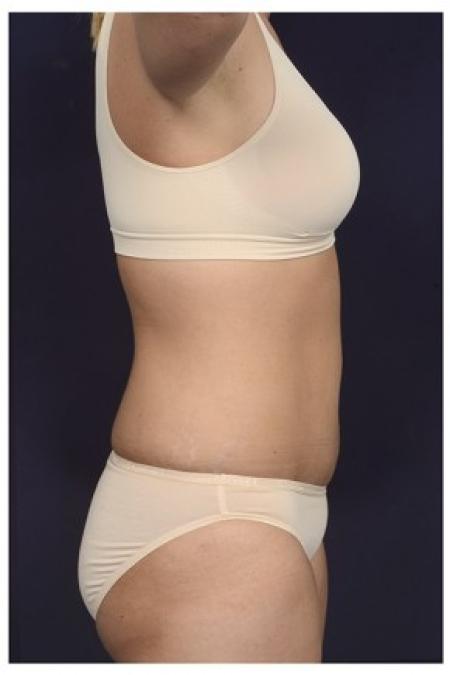 After image 3 Case #84511 - Abdominoplasty