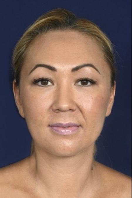 After image 1 Case #87581 - Lower Facial Rejuvenation
