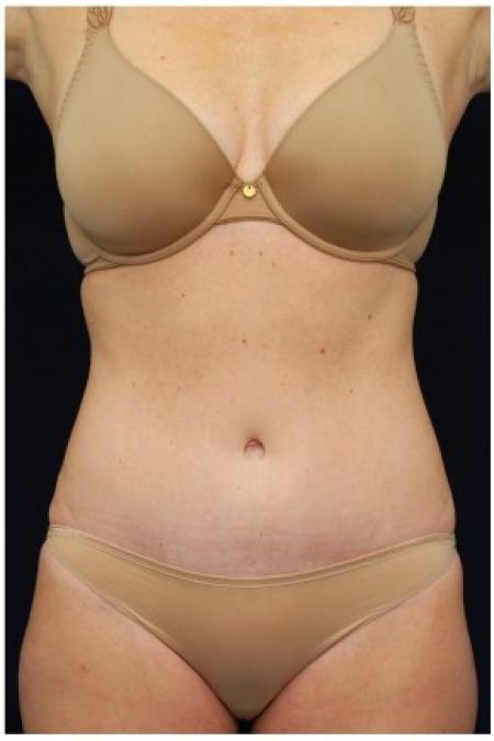 After image 1 Case #82106 - Tummy Tuck