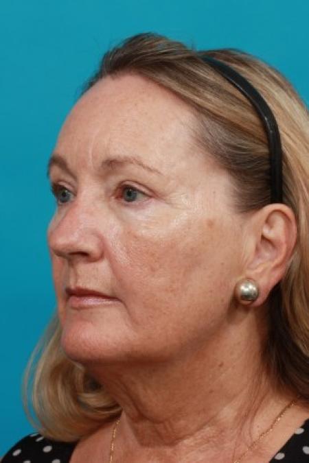 After image 2 Case #86036 - Quad Blepharoplasty
