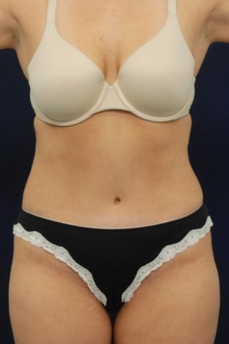 After image 1 Case #82166 - Tummy Tuck