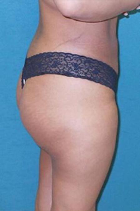 After image 1 Case #84911 - Buttock Augmenation with implants and liposuction of the abdomen