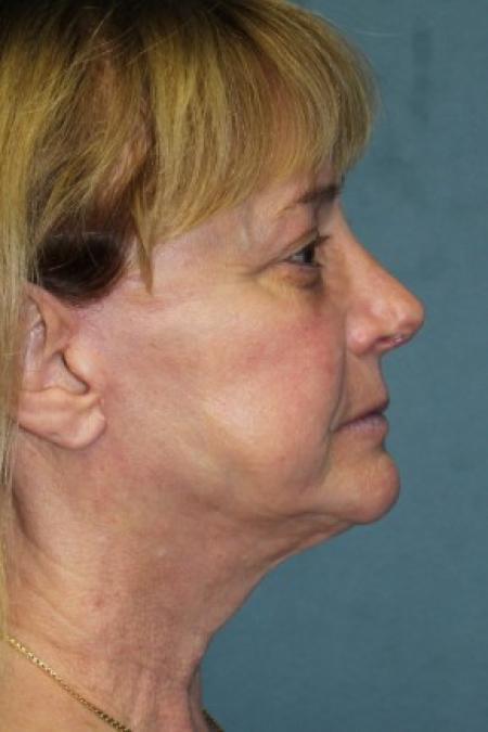After image 3 Case #81081 - Facelift