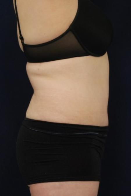 After image 3 Case #87696 - Abdominoplasty