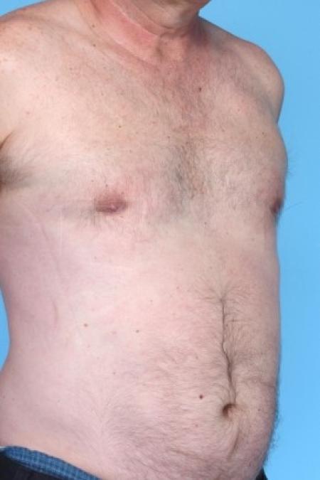 After image 1 Case #81211 - Liposuction